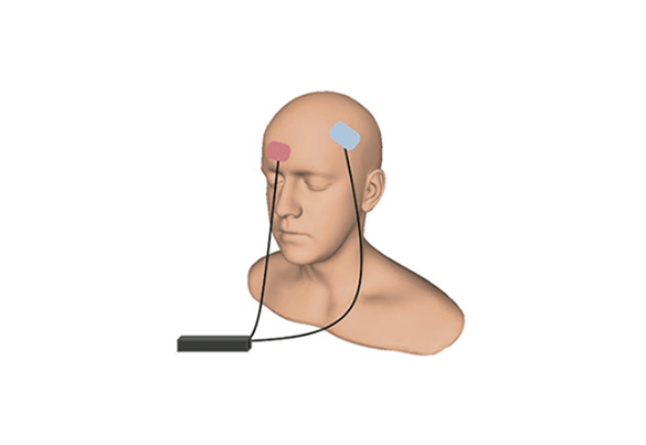 tDCS - Estimulação Transcraniana de Corrente Contínua